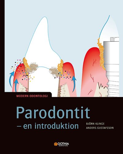 Parodontit